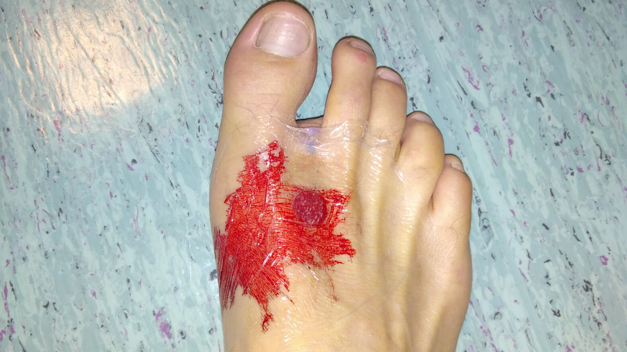 foot_implant3